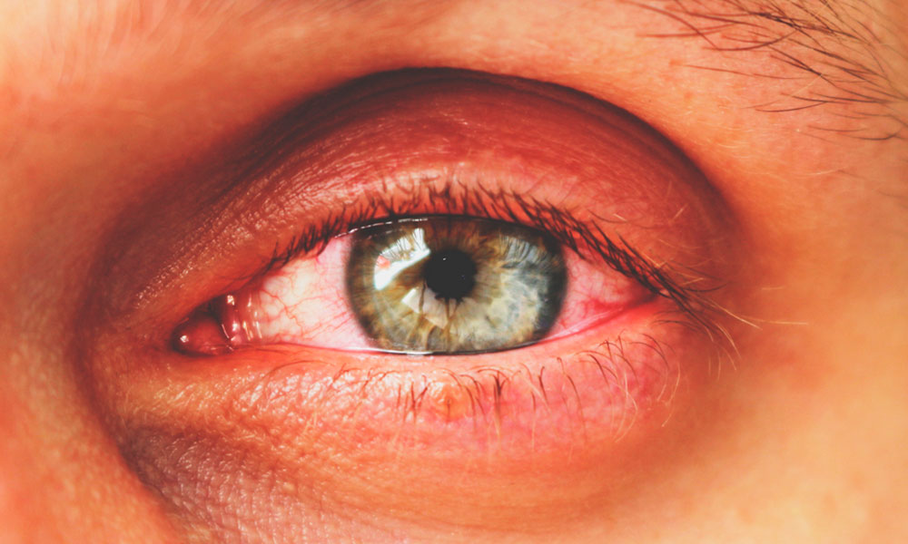 Las alergias oculares afectan más a la población urbana que a la rural