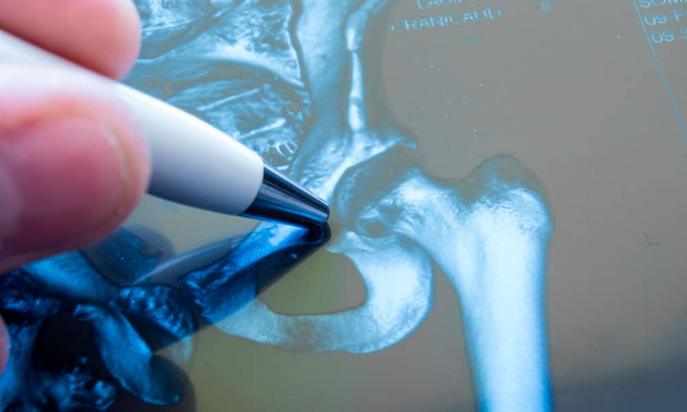 La fractura de cadera es una de las lesiones más frecuentes en la población mayor de 65 años