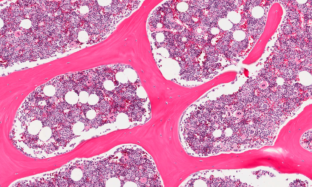 Claves del síndrome mielodisplásico, una enfermedad de las células de la médula ósea