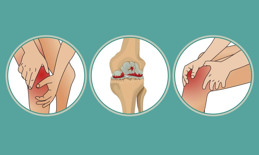 Lo que debería hacer si padece artritis en sus rodillas