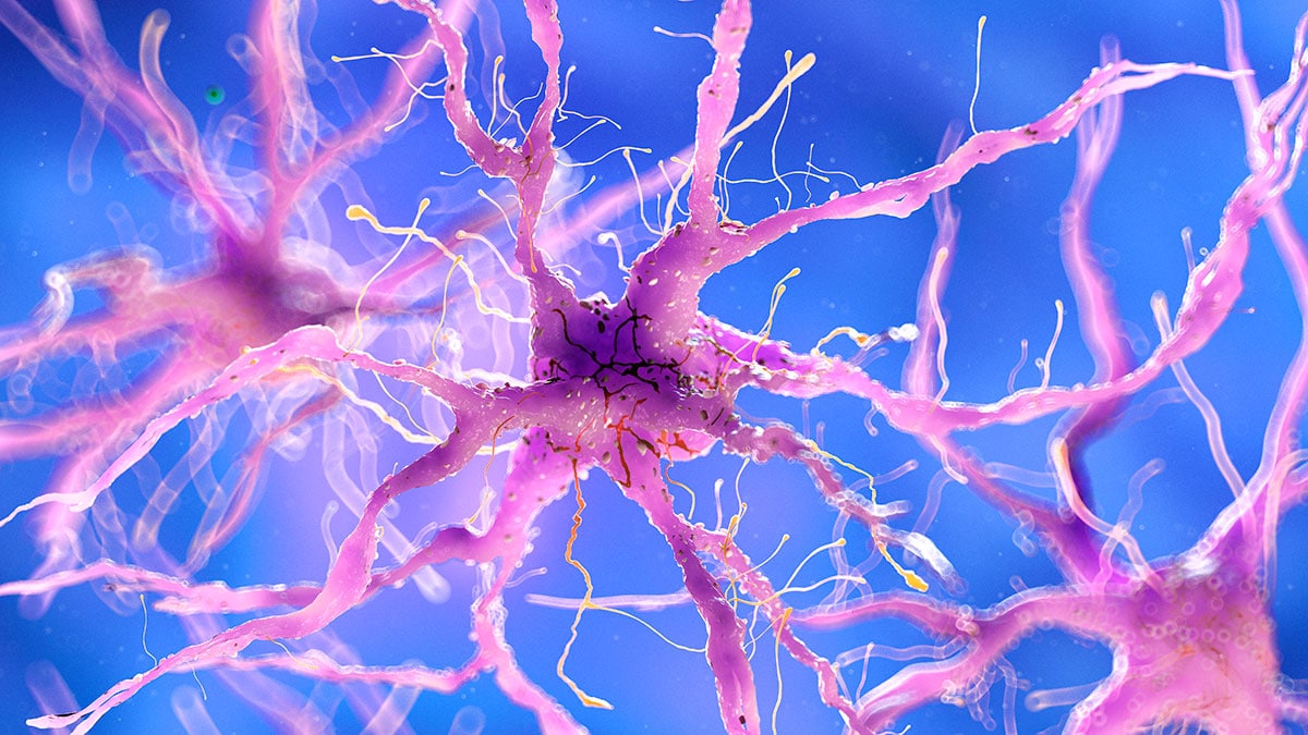 Hallan donde comienza a acumularse las placas de amiloide en Alzheimer