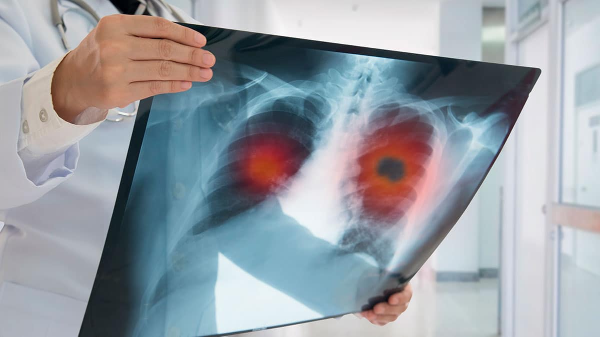 Google y Northwestern desarrollan un modelo de aprendizaje profundo para la detección del cáncer de pulmón