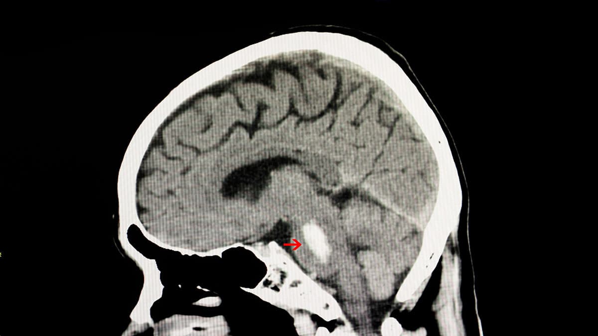 Un estudio identifica la lesión cerebral como una causa de demencia en adultos