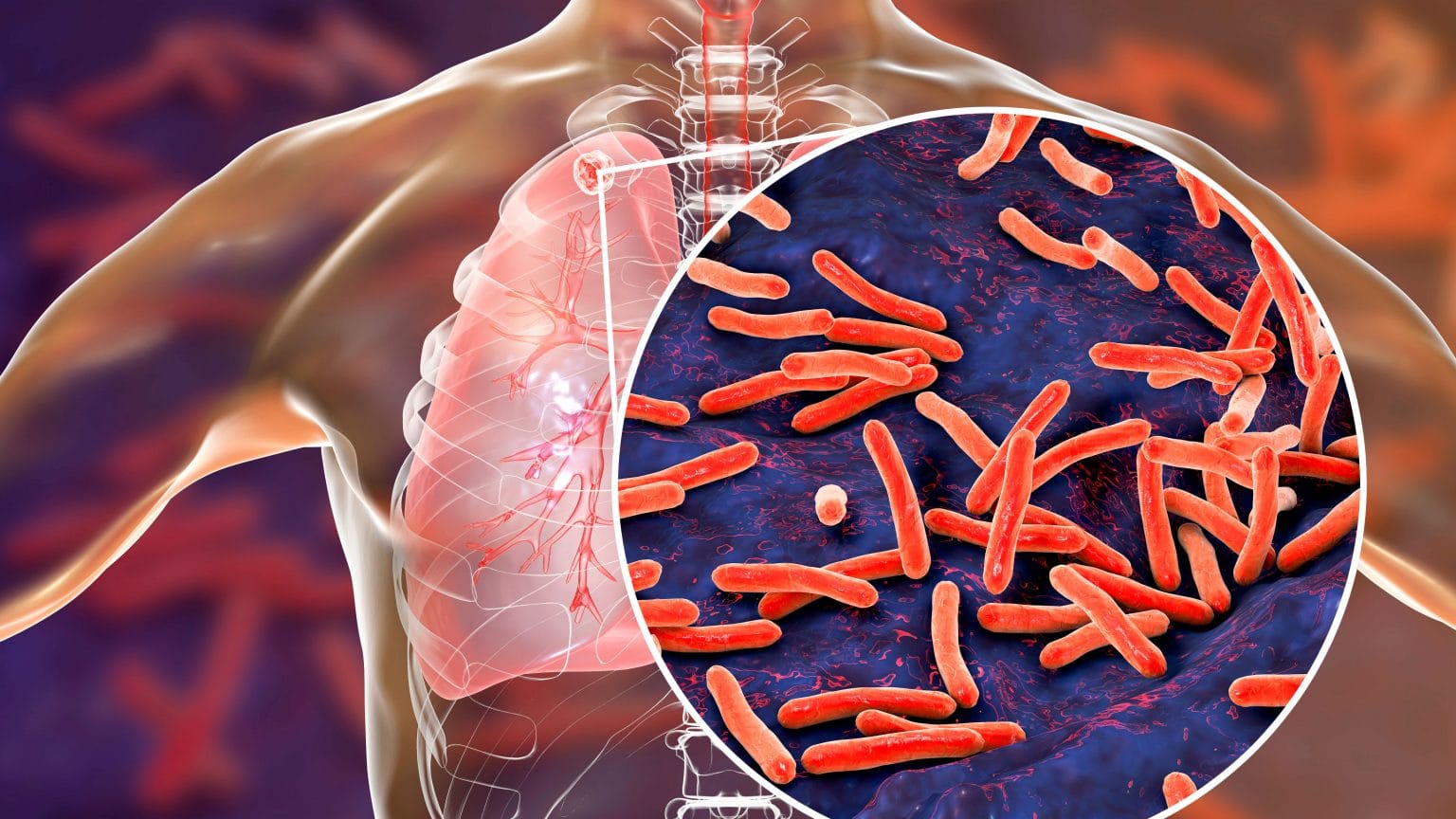 Posibles respuestas inmunes a la tuberculosis