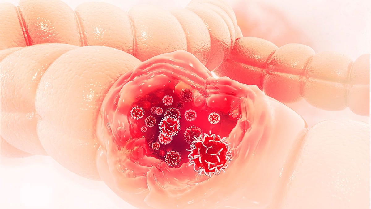 Detección y diagnóstico del cáncer de colon
