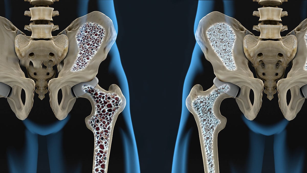 ¿Sabes qué es la osteoporosis y cuáles son sus factores de riesgo?