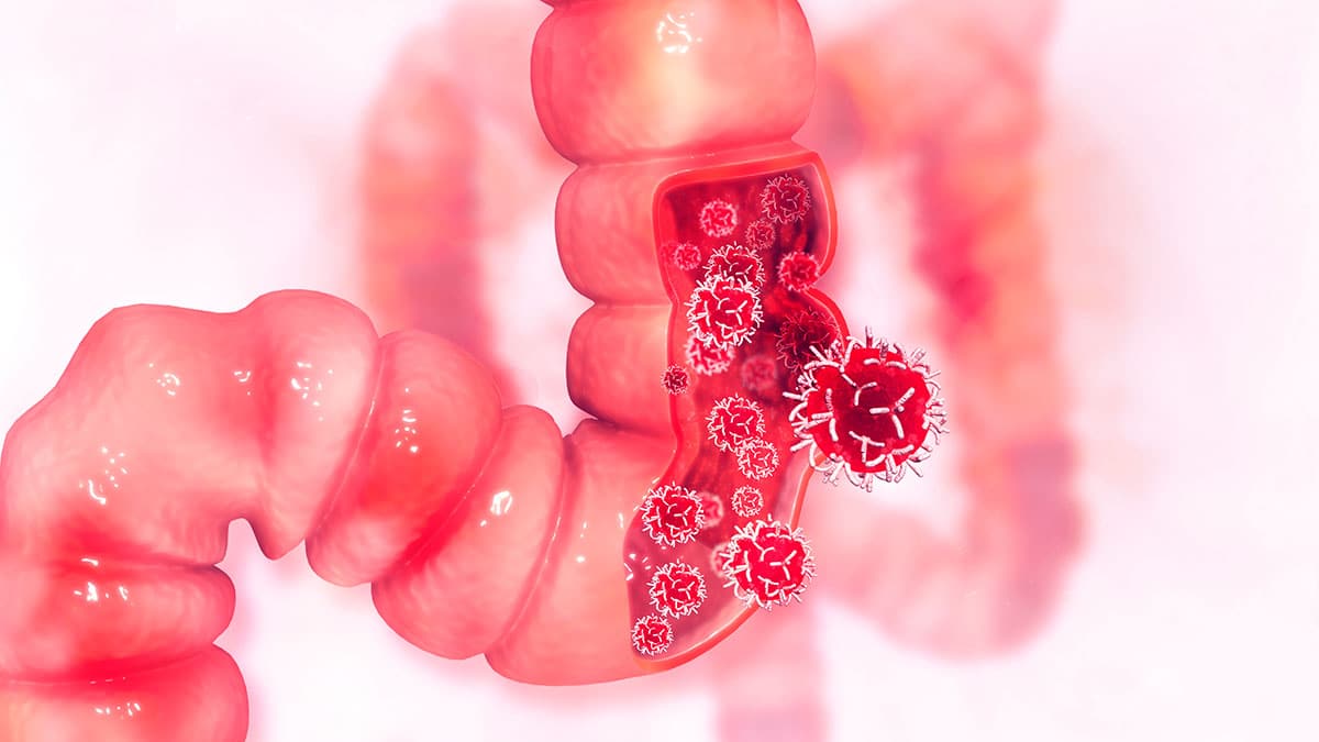 Los tumores digestivos provocan alrededor de 30.000 muertes al año en España