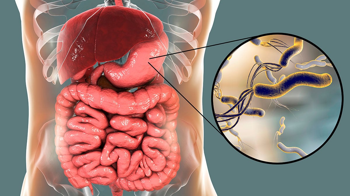 La infección por Helicobacter pylori es la principal causa de úlcera gastroduodenal y afecta al 40% de la población