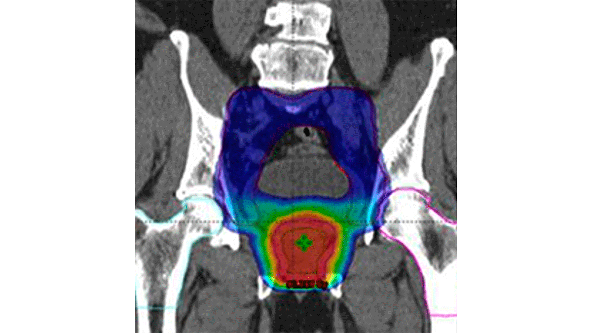 Nuevas técnicas de radioterapia mejoran el control y la supervivencia del cáncer de próstata