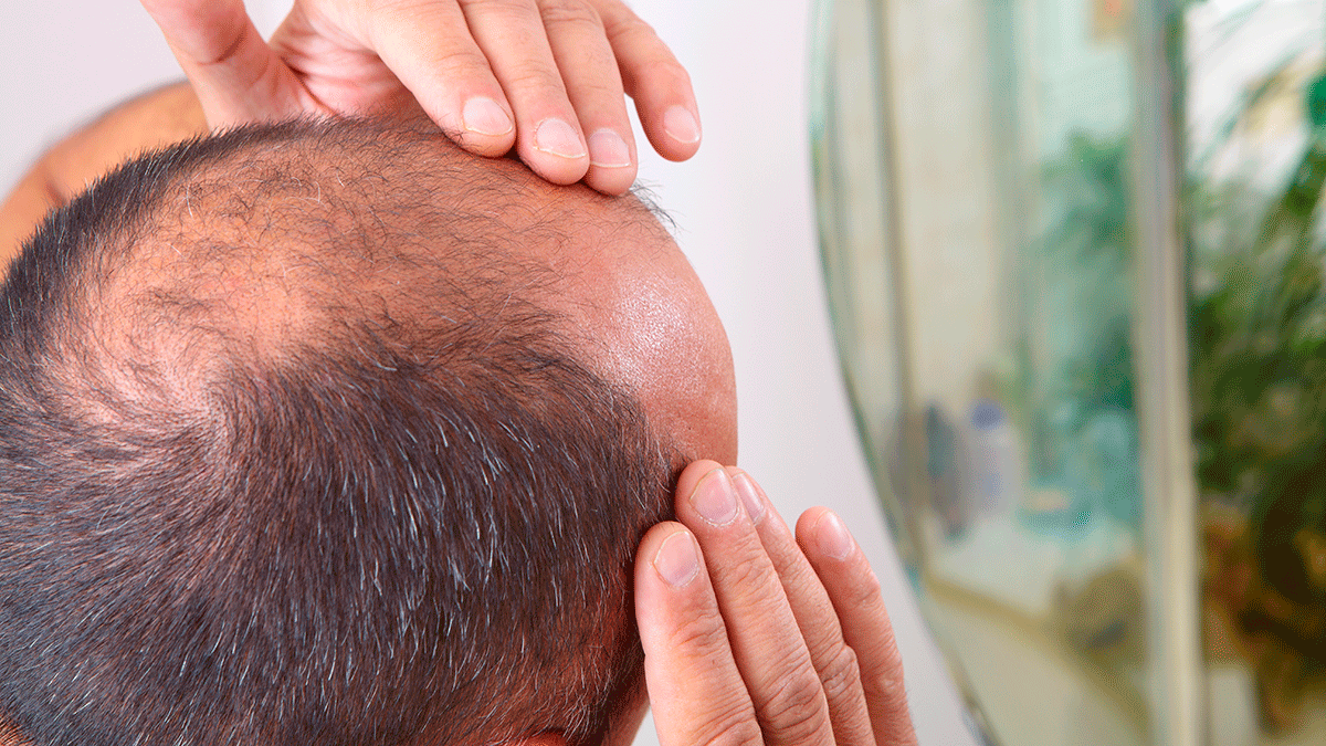 ¿Cómo poner fin a la alopecia? Mejores tratamientos capilares para frenar la calvicie